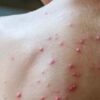 نيويورك : تسجيل أوّل إصابة بجدري القردة