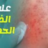 مستشفى سهلول : طبيبة مختصة في الأمراض الباطنية تكتشف دواء جديد  لعلاج الذئبة الحمراء